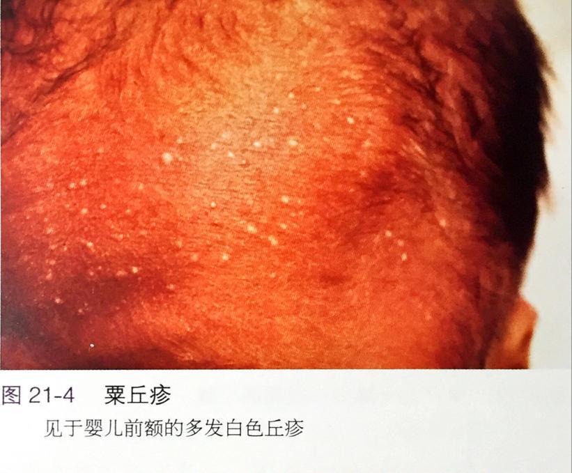 宝宝脸上的白色小点点——新生儿粟丘疹(milium)