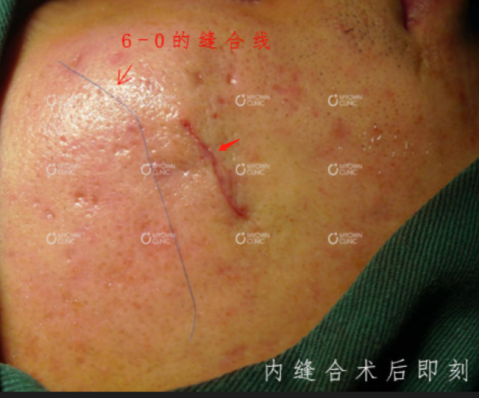 手术缝合针线怎么消毒什么样的缝合才算是美容缝合？_https://www.jmylbn.com_新闻资讯_第6张