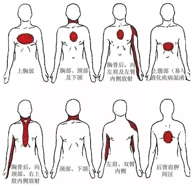 心梗位置判断 图图片