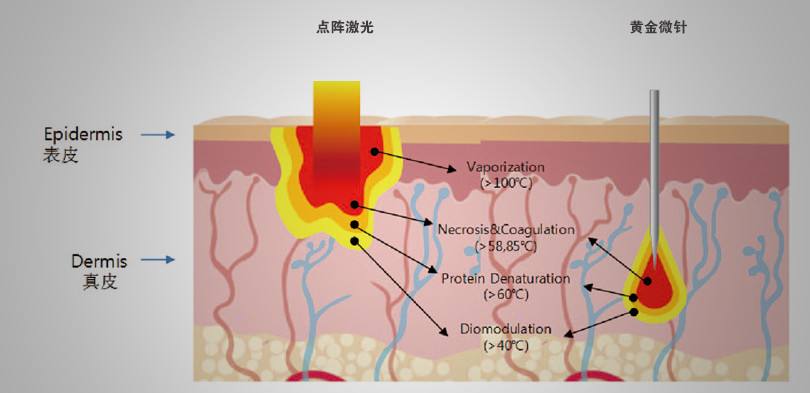 点阵激光重建皮肤为什么那么火_何金生_副主任医师_爱问健康