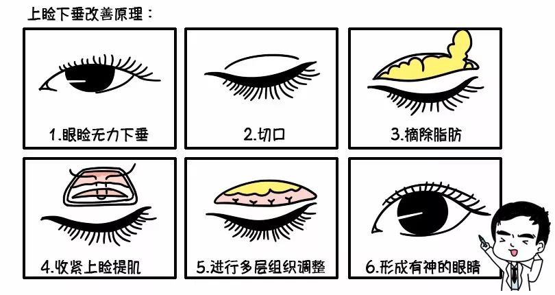 因为上睑下垂矫正手术的切口也在上睑,很多人做完单纯的上睑下垂之后