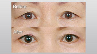 难看的"三角眼"是怎样形成的?_张姣姣_主任医师_爱问健康