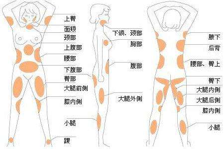 吸脂部位分布图.jpg
