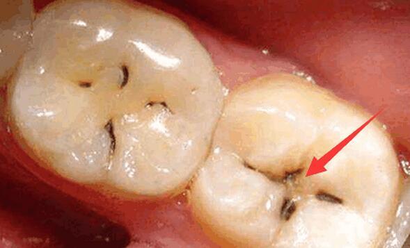 光泽的白垩色斑点,或两牙相邻处有变暗的黑晕,这都是虫牙的早期表现