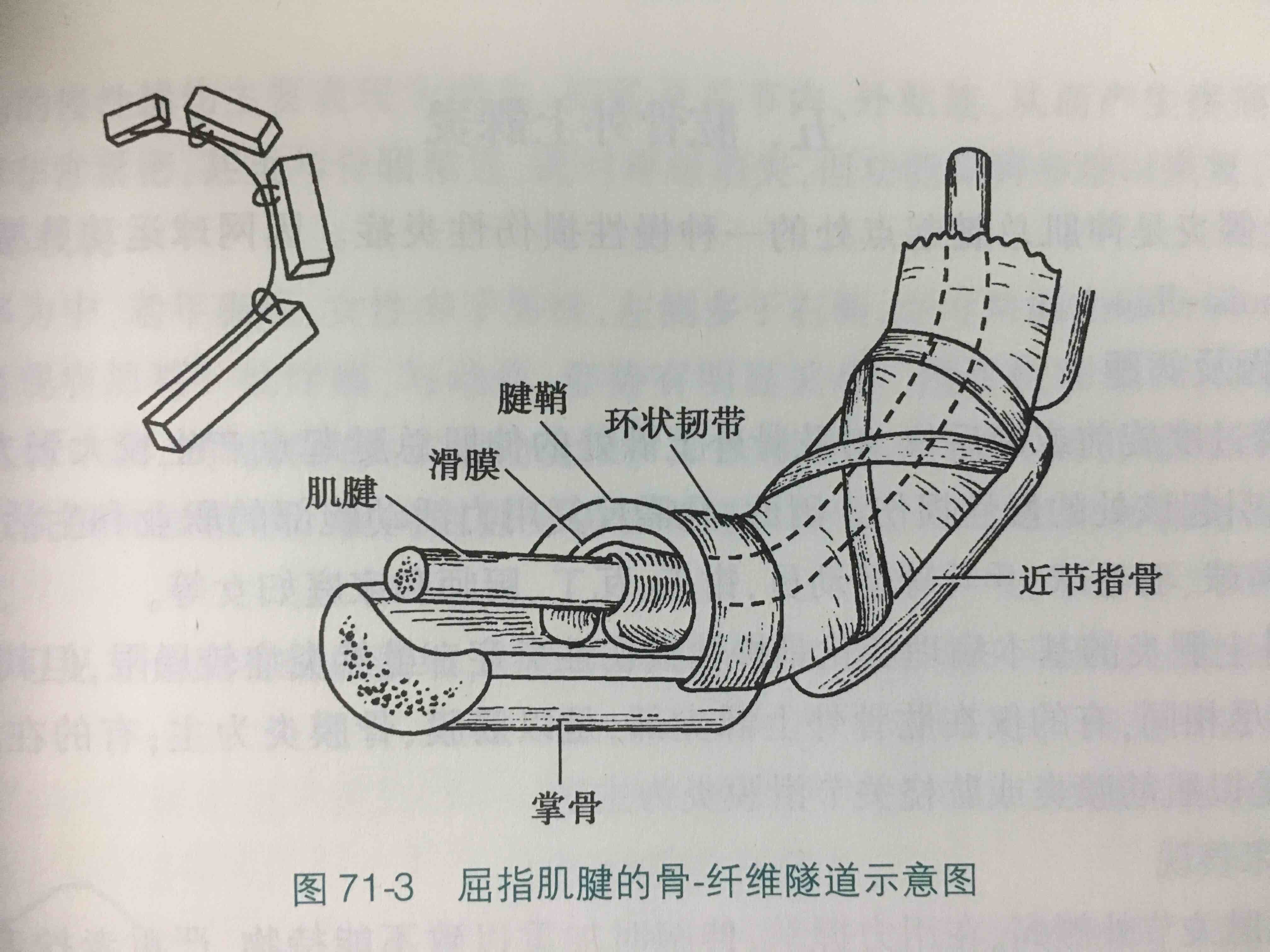 屈指肌腱腱鞘炎图片