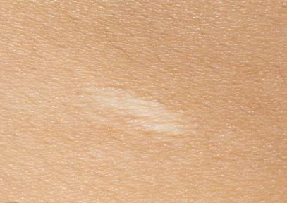 表浅性瘢痕临床特征及治疗原则