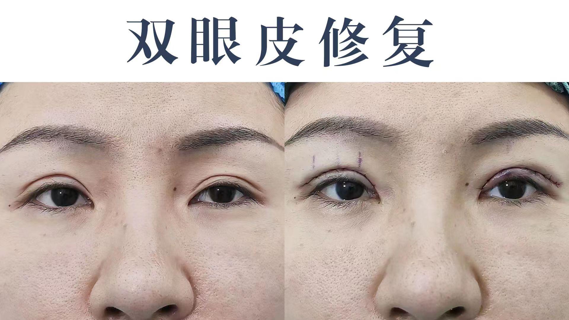 双眼皮形态做了平行型显老不自然怎么办?做双眼皮修复可以改善_孔宇_主任医师_爱问健康