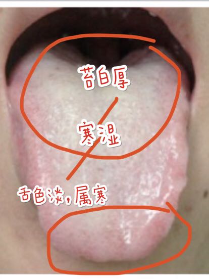 湿气舌苔对照图片图片