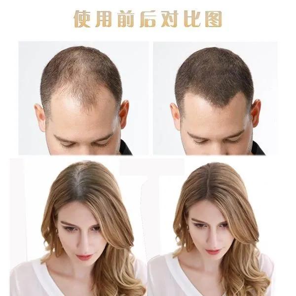 女性发量少、脱发严重是种什么样的体验？（附女性毛发改善方法）_刘长春_主任医师_爱问健康