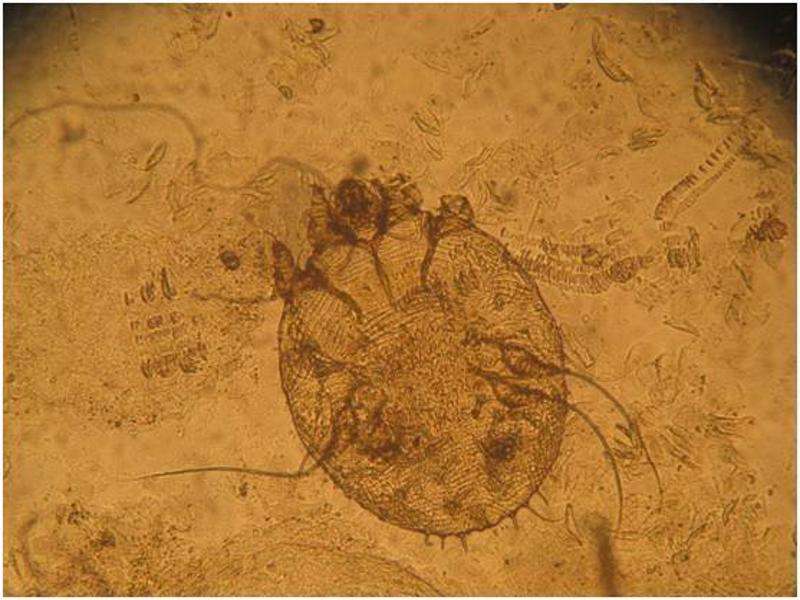 疥虫显微镜下形态疥虫显微镜下形态治疗方法:①盐酸奥洛他定片口服