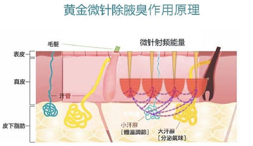 “腋臭福音”—感受精准无痕黄金微针给你带来的芬芳夏季_王海珍_副主任医师_爱问健康