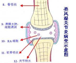 类风湿关节炎病变示意图jpeg