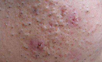 鸡 皮 肤"鸡皮肤",又叫毛周角化症,一般是基因导致的体质,具有这种