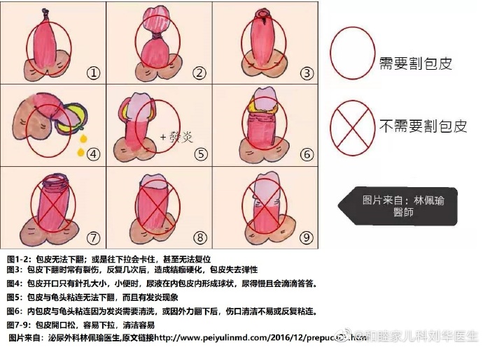 男童包茎粘连怎么办图片