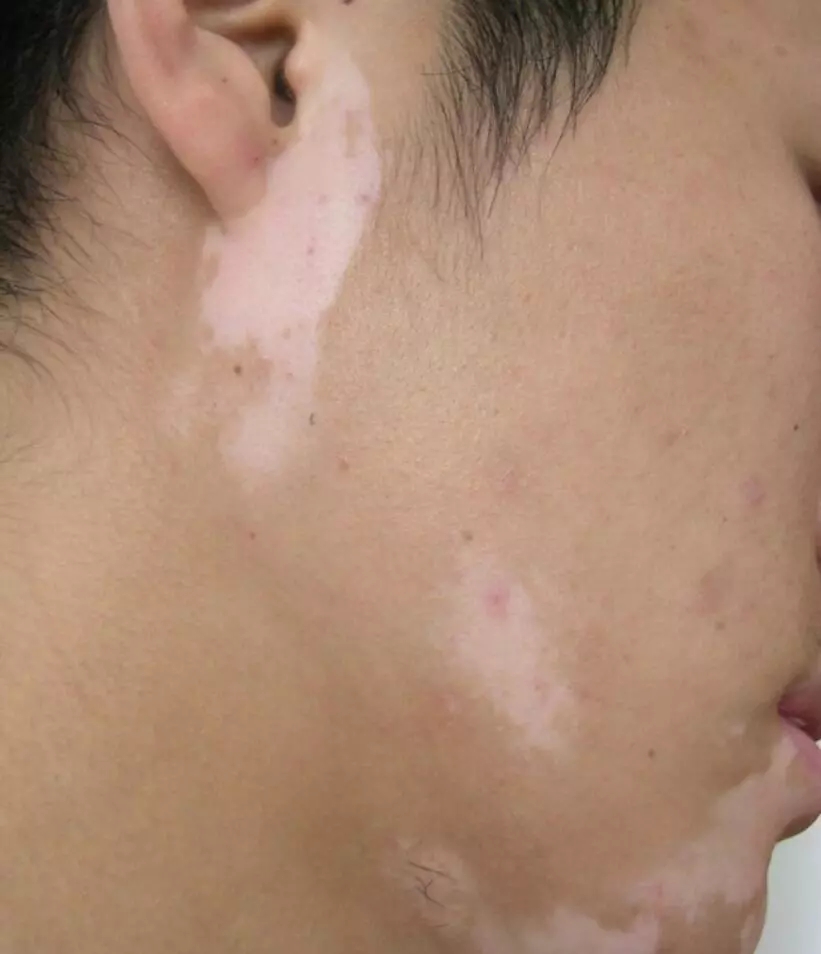 "白斑"不等于"白癜风"_杨希川_主任医师_爱问健康