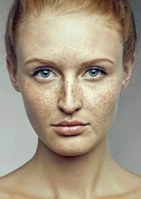 治疗黄褐斑你选择西医还是中医