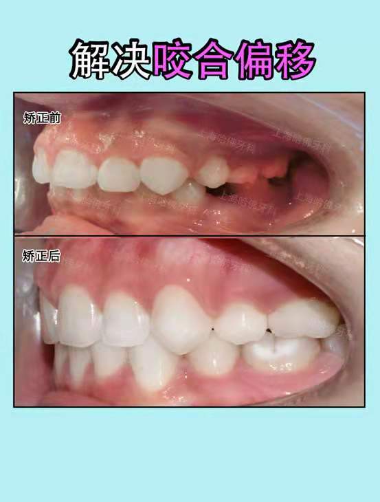 患者在治疗前的咬合功能很低,面条都吃不断;同时牙齿的稳定性也极低