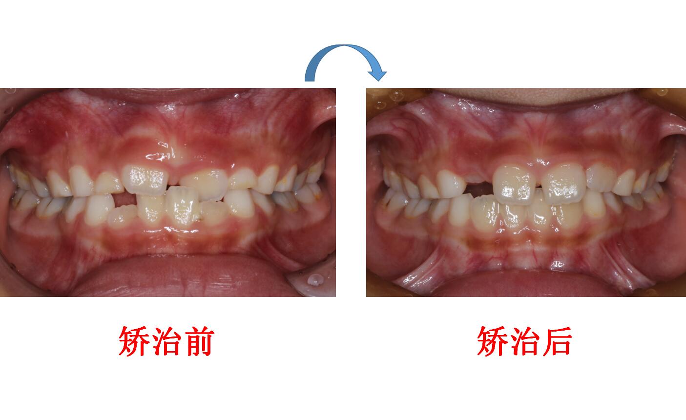 邓艳洁前牙反合矫治前后对比 (1).jpg