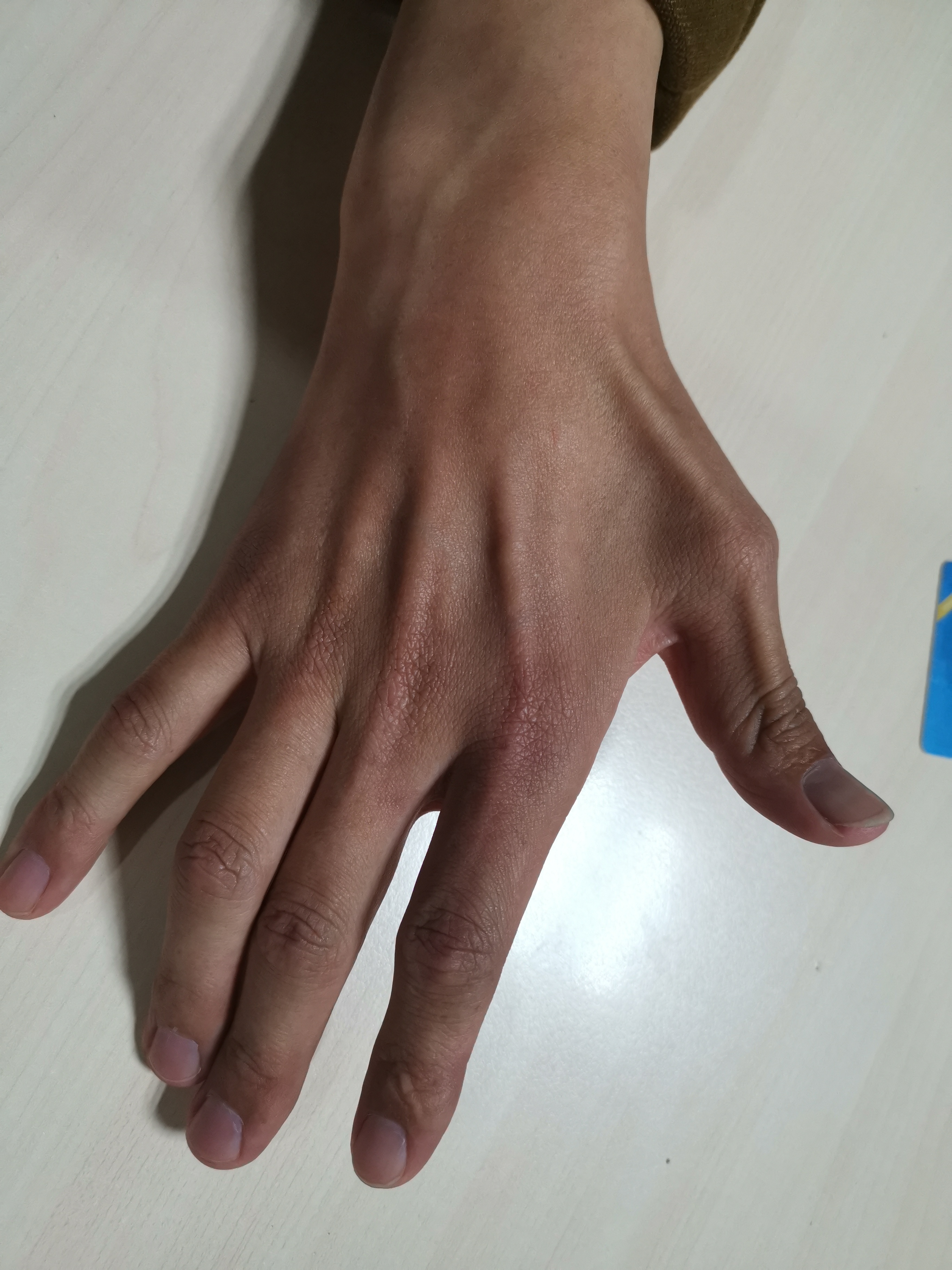 尺神经卡压导致手肌肉萎缩_陈江海_副主任医师_爱问健康