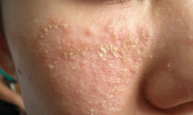 脂溢性皮炎泛指发生在脂溢(出油多)部位,如头皮,面部
