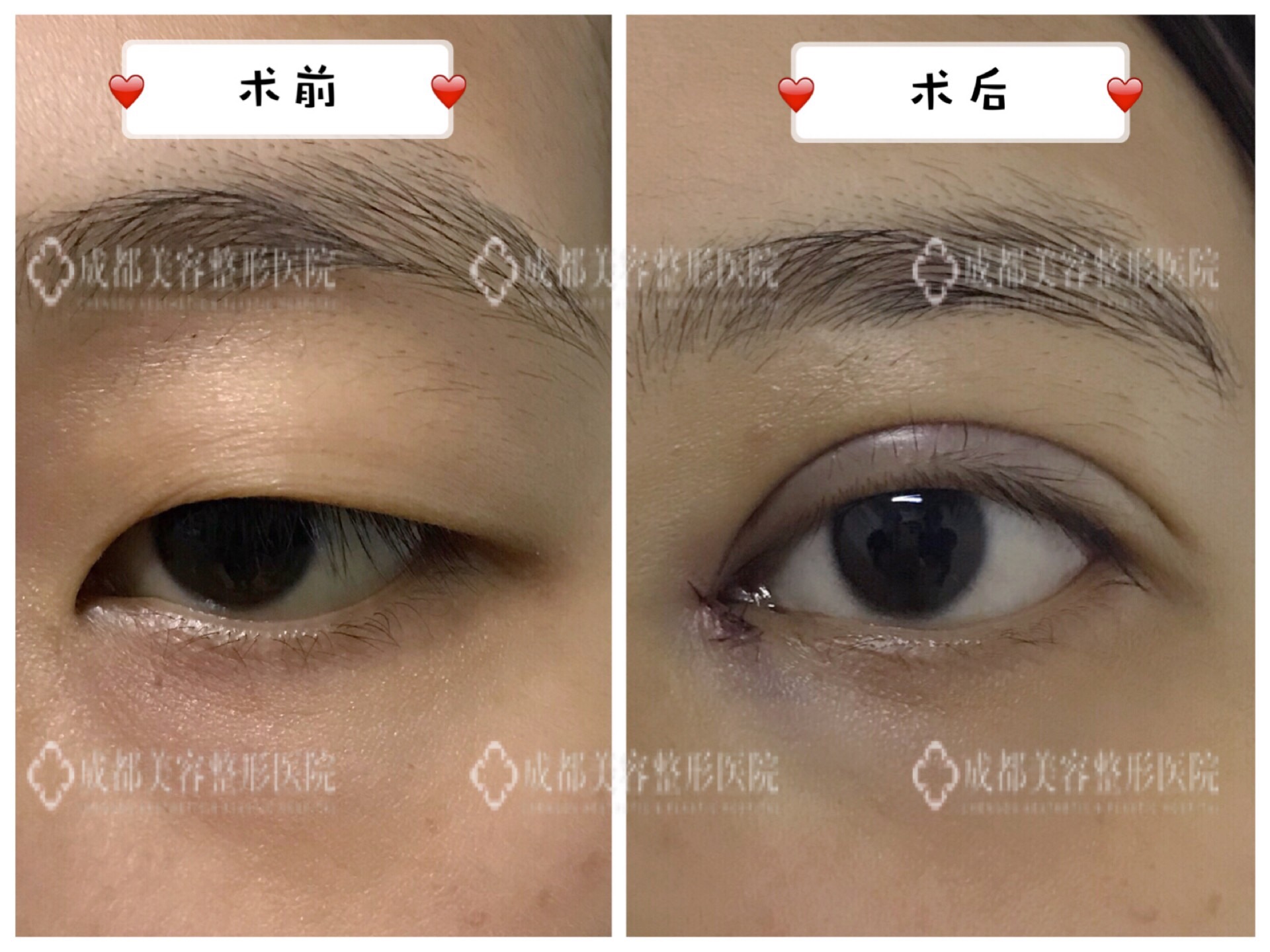 什么是内眦赘皮? 开内眼角详细过程解说!_王立鹏__爱问健康