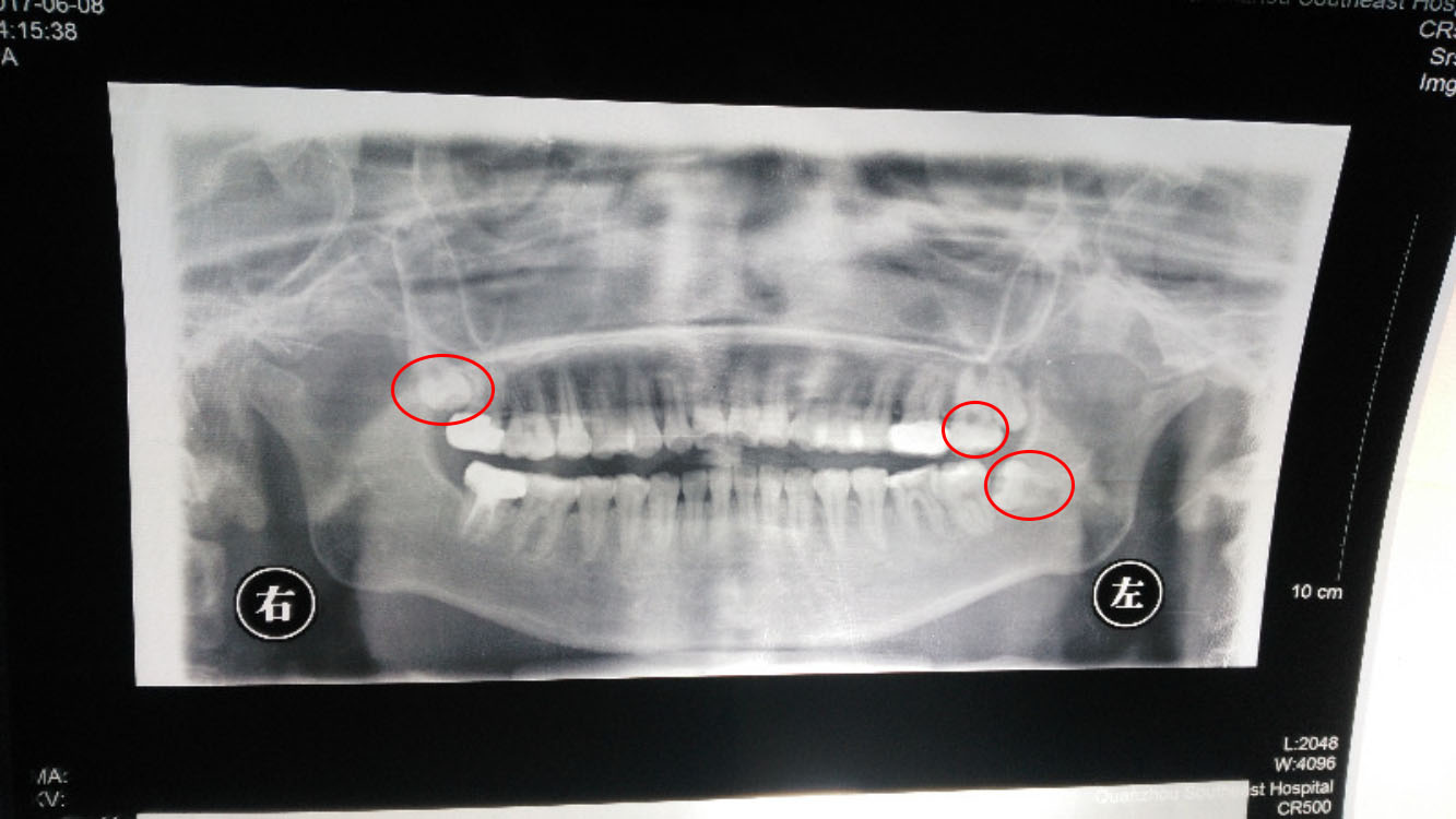 牙科x光片拍摄角度图片