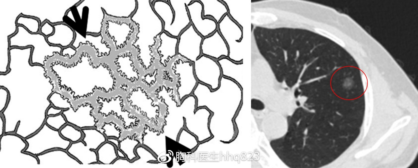 图3  肺泡壁增厚，肺泡腔缩小。图4  肺内纯磨玻璃结节。