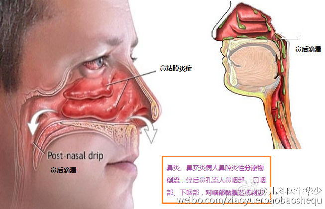 鼻后滴流图片