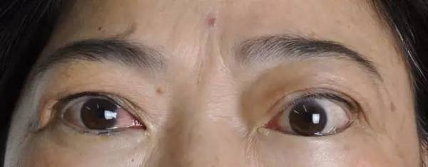 关于眼整形要知道的事(十二)双眼皮手术后,出现上睑外翻怎么办
