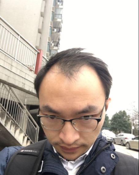 秃头的前兆是怎么样的,如何摆脱“秃子危机”?_刘长春_主任医师_爱问健康
