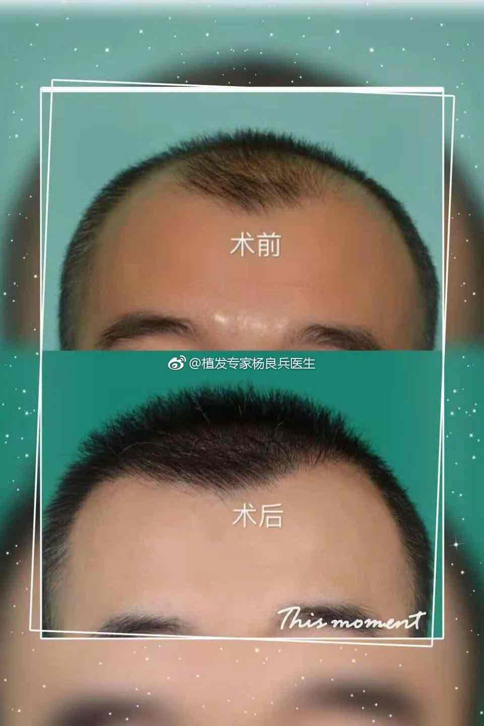 种发和植发骗局(种发和植发骗局的区别)