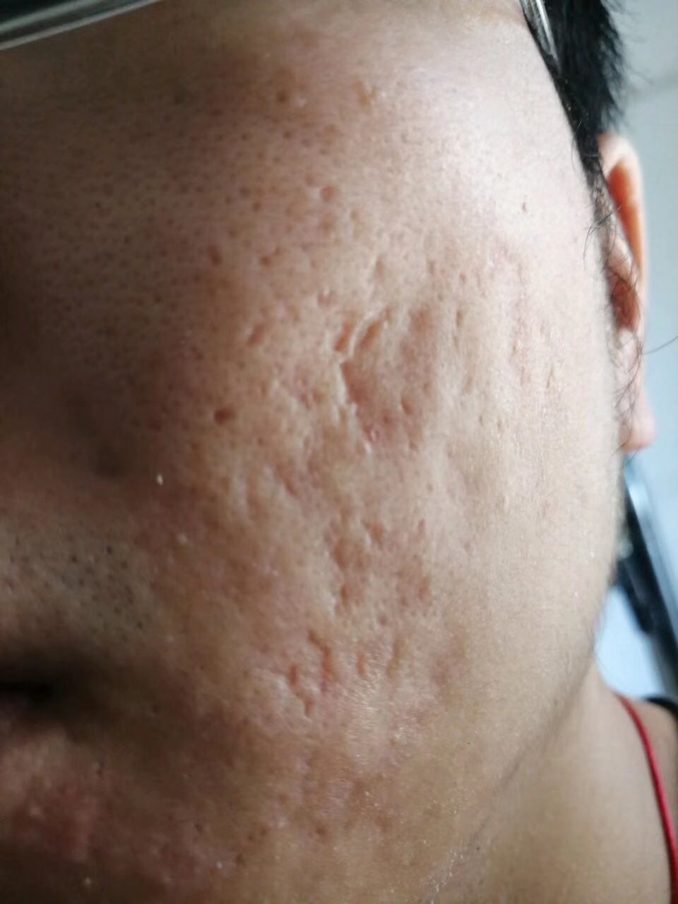 吴医生,您好,我的脸上的痘坑看起来好严重,您有什么好的方法吗
