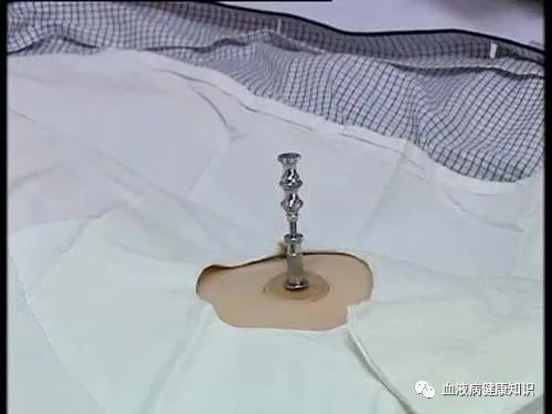 然而,多数患者对这个检查都充满了恐惧,认为做骨穿,抽骨髓对身体是有