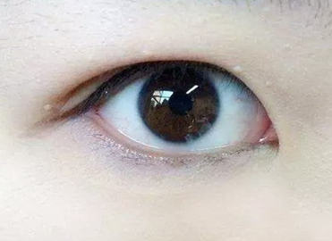内双也可以割双眼皮吗?_黄良飞_主治医师_爱问健康