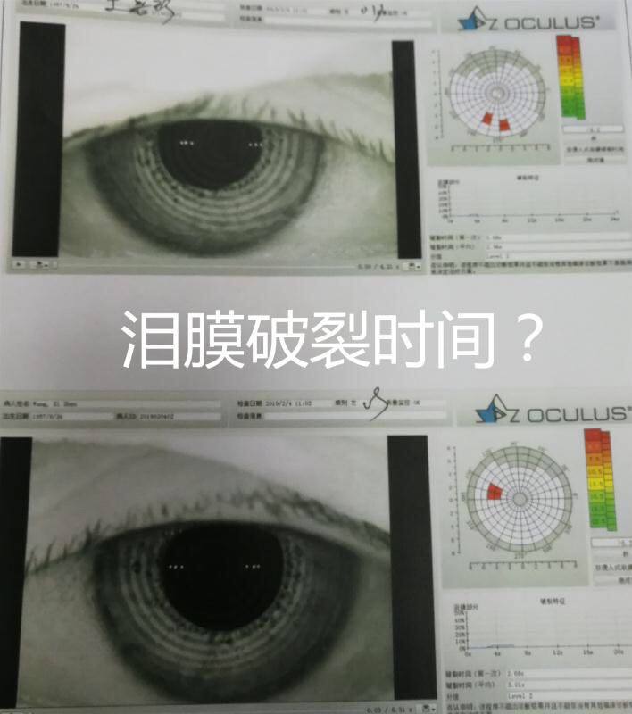 关于流泪和溢泪以及干眼的思考_程勉征_副主任医师_爱问健康