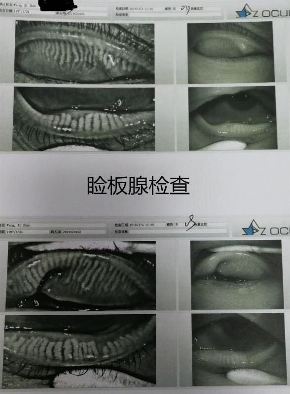 关于流泪和溢泪以及干眼的思考_程勉征_副主任医师_爱问健康