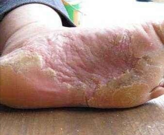 足底有几块硬皮,咋回事?