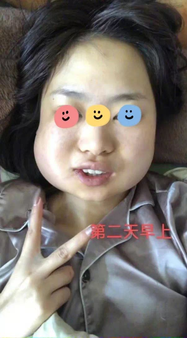 千万别把智齿一次性拔完不然你的脸会变这样