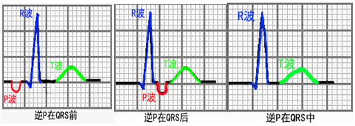 4,逆行p波:p波是心房除极过程的电活动表现,正常p波起源于窦房结,而