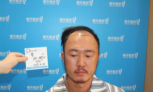 如何判断脱发的类型?(附带额角、秃顶改善)_刘长春_主任医师_爱问健康