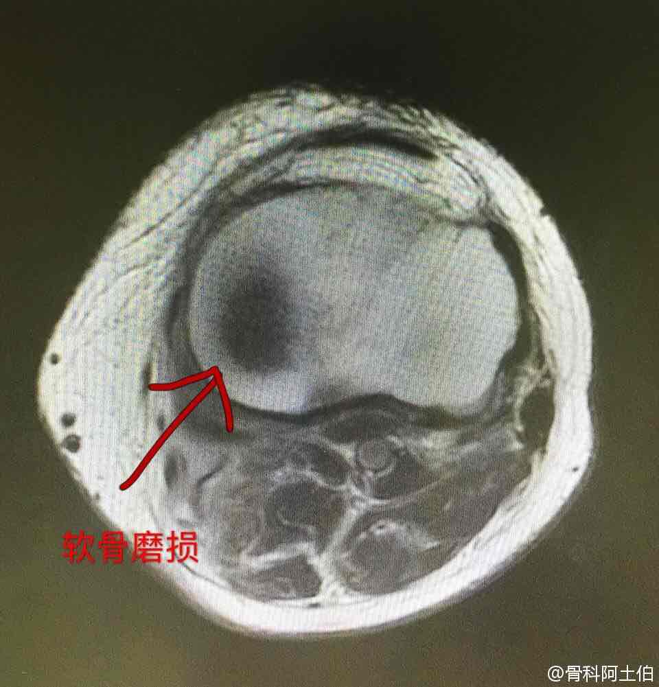 明确半月板三度损伤该怎么处理!