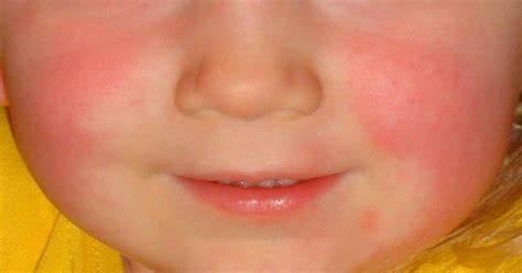 红皮疹、草莓舌，一种好发于儿童的传染病：一文带您认识猩红热！