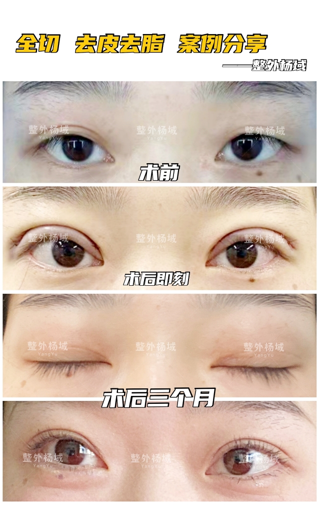 科普丨做双眼皮需要考虑哪些?才能做的好看又适合自己_杨域__爱问健康