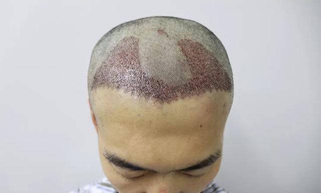爱长发飘飘的男人,额角逐渐后移呈现M型,植发2450单位改变_刘长春__爱问健康