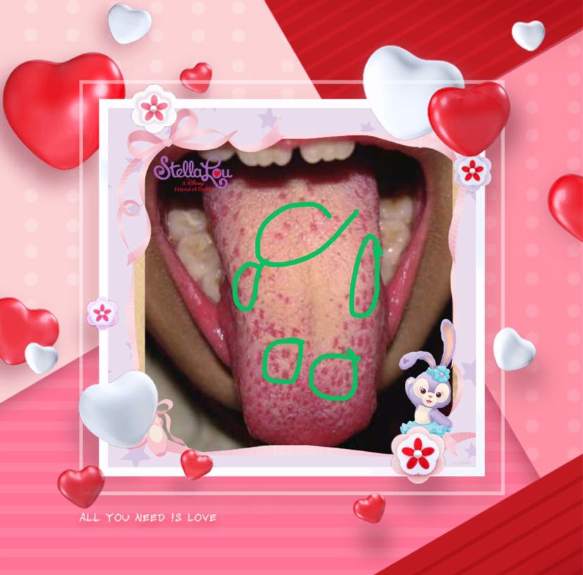 每天一条中医舌像小知识1⃣5⃣:舌上小红点_刘夏菲_主治医师_爱问健康