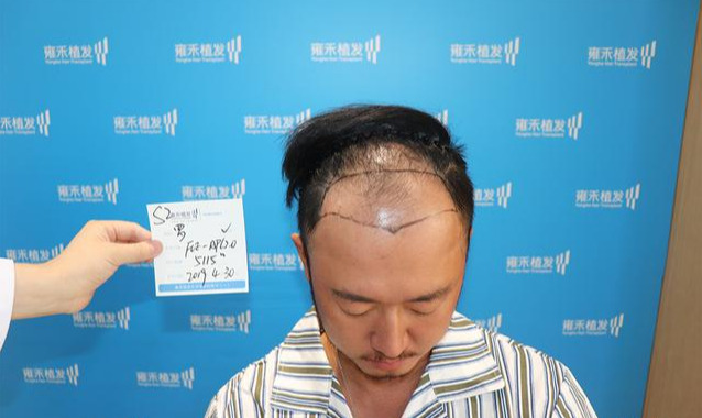 如何判断脱发的类型?(附带额角、秃顶改善)_刘长春_主任医师_爱问健康