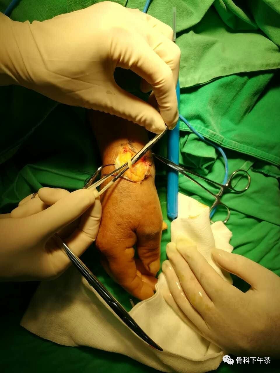 保护肌腱切除囊肿缝合皮肤(皮下缝合,再见了,难看的"蜈蚣脚")囊肿内