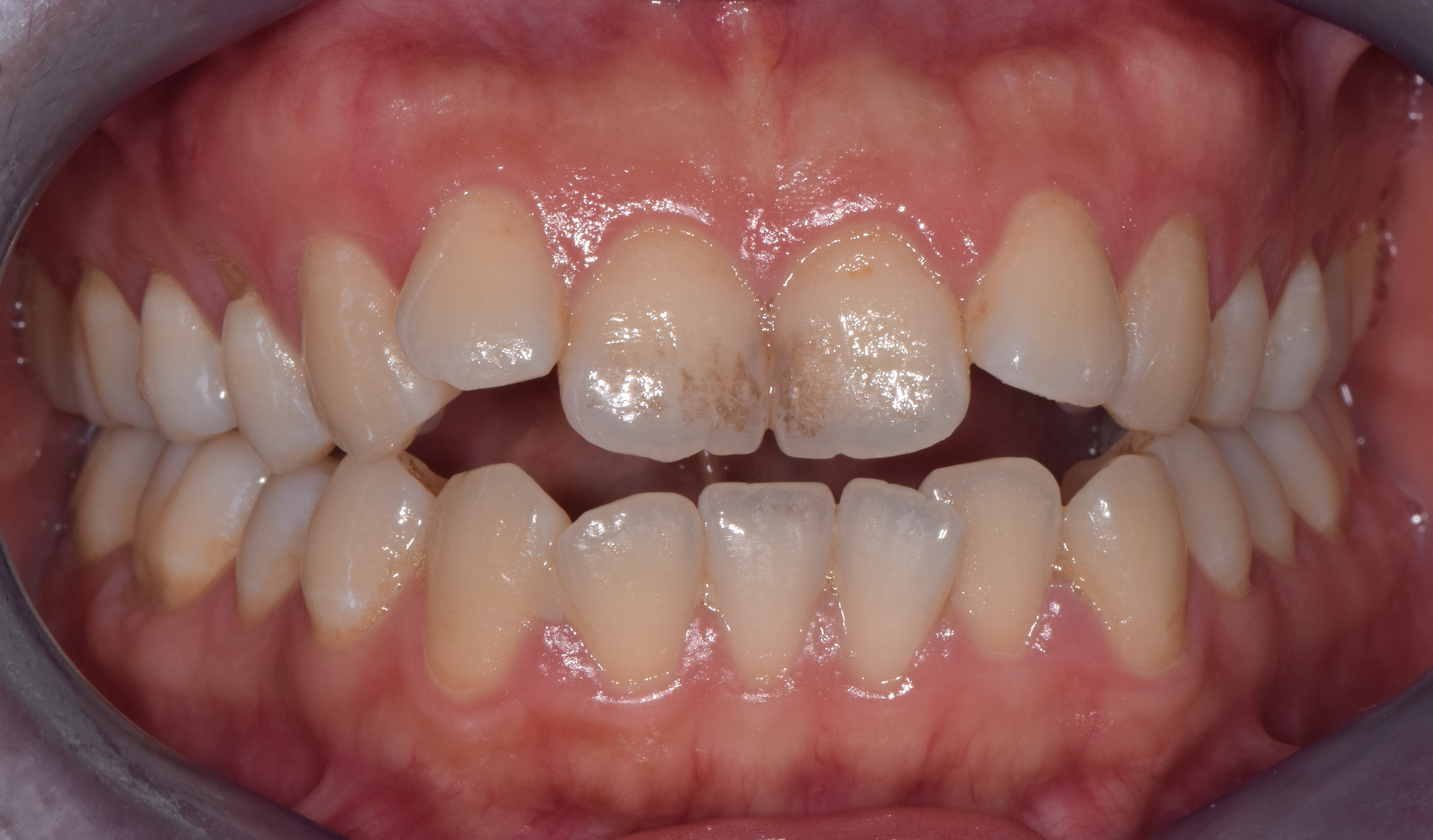 开颌矫正第一招:压低后牙,前旋下颌_梁爱燕_主治医师_爱问健康