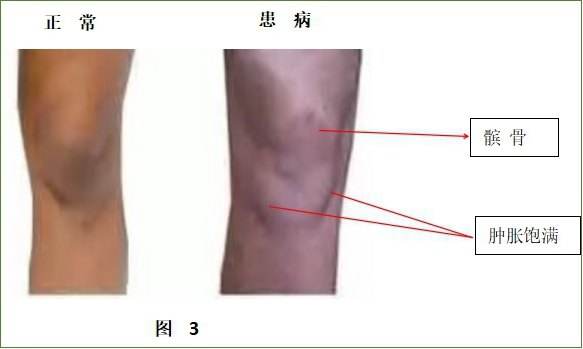 腿不直还膝盖痛?膝关节第一杀手【Q角】了解一下_陈博闻__爱问健康