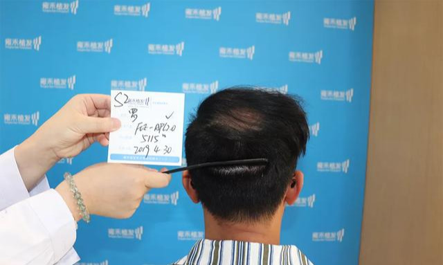 如何判断脱发的类型?(附带额角、秃顶改善)_刘长春_主任医师_爱问健康
